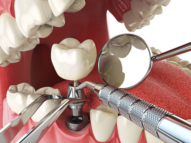 Best Knocked-Out Tooth (Avulsed Tooth) Treatment in Devon, PA